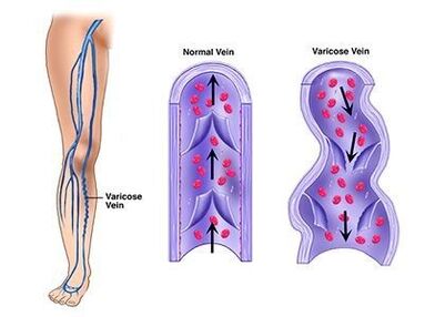 Neoveris previne dezvoltarea patologiilor venelor