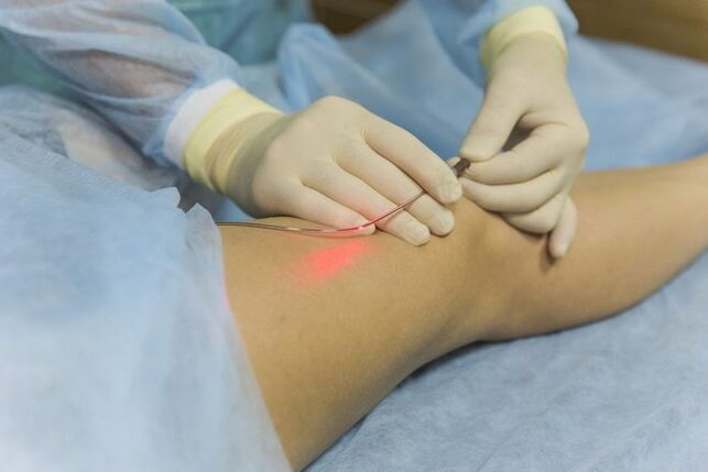 Tratamentul cu laser al venelor varicoase