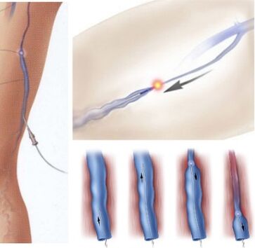 metoda de tratare a venelor varicoase - coagulare laser endovenoasa