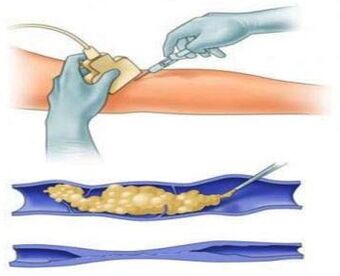 scleroterapia este o metodă de tratare a venelor varicoase