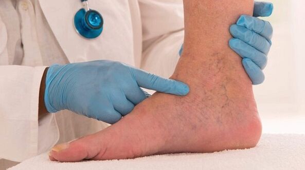 medic care examinează picioarele cu vene varicoase